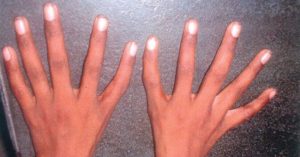 Hội chứng “tay người ngoài hành tinh” khiến ngón cái… biến thành ngón trỏ