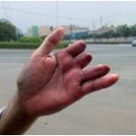 Phẫu thuật thay ngón tay bằng ngón chân