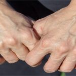 Đây là lý do một số người có làn da nổi gân guốc nhiều hơn hẳn phần còn lại