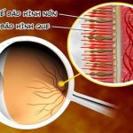 Làm thế nào để biết bản thân đang mắc bệnh mù màu?