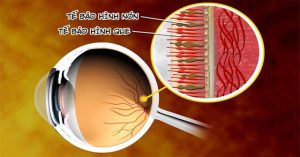 Làm thế nào để biết bản thân đang mắc bệnh mù màu?