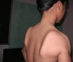 Bệnh ‘chim sệ cánh’ ở trẻ em có thể do tiêm chủng