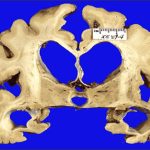 Não teo lại trước khi phát hiện bị bệnh Alzheimer