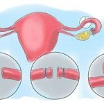 Những điều cần biết về triệt sản ở nam và nữ
