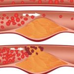 Đã có thuốc trị nhồi máu cơ tim và đột quỵ