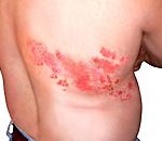 Thủy đậu – tiền thân của bệnh giời leo