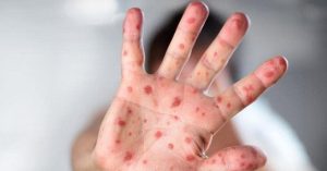 Tổ chức Y tế Thế giới coi việc từ chối tiêm vắc-xin là mối đe dọa toàn cầu trong năm 2019