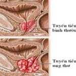 Thuốc mới điều trị ung thư tiền liệt tuyến