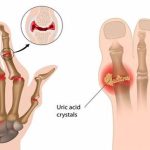 Bệnh Gout: Nguyên nhân, triệu chứng và cách điều trị