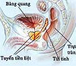 Cắt bỏ tuyến tiền liệt dễ gây bất lực