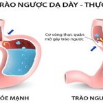 Cách ngăn chặn tình trạng trào ngược axit dạ dày