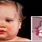 Làm gì khi con trẻ mắc quai bị?