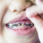 Vì sao trẻ con luôn bị sâu răng?