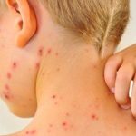 Con đường lây lan bệnh sởi
