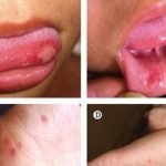 4 sai lầm khi chăm sóc trẻ mắc bệnh tay chân miệng