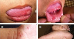 4 sai lầm khi chăm sóc trẻ mắc bệnh tay chân miệng