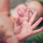 Vì sao chủng virus EV71 gây bệnh tay chân miệng nguy hiểm đến mức tử vong?