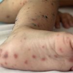 Vaccine phòng tay chân miệng đầu tiên ở Việt Nam có hiệu quả 96,8%