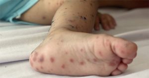 Vaccine phòng tay chân miệng đầu tiên ở Việt Nam có hiệu quả 96,8%