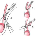 Bác sĩ triệt sản cho đàn ông như thế nào?