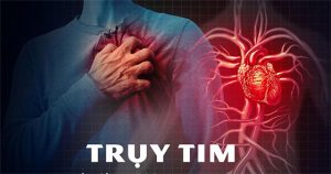 Trụy tim: Nguyên nhân, triệu chứng và cách điều trị