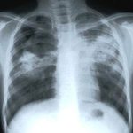 Thành công trong điều chế vaccin mới phòng lao
