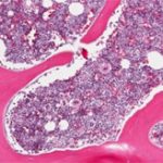 Ghép tủy xương trị AIDS