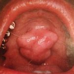 U lồi xương răng khiến nhiều người lo sợ bị ung thư