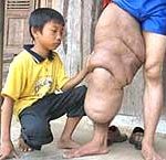 Người đàn ông có chiếc “chân voi”