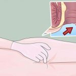 Dấu hiệu sớm cảnh báo bạn bị ung thư hậu môn