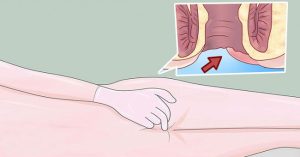 Dấu hiệu sớm cảnh báo bạn bị ung thư hậu môn