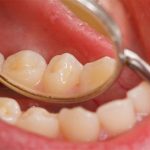Dấu hiệu cảnh báo ung thư khoang miệng