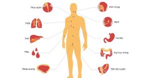 Tỷ lệ đàn ông Việt Nam chết vì ung thư thuộc loại cao nhất thế giới