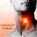 Phát hiện các biến thể gene gây ung thư thực quản
