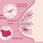 Triệu chứng và cách phát hiện ung thư vú