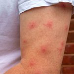 Cùng ở một chỗ, vì sao có người bị muỗi chích nhiều, người thì không?