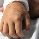 Chuyên gia chỉ ra 5 sai lầm khi sơ cứu người bị rắn độc cắn