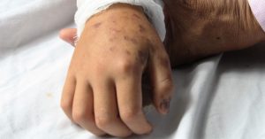 Chuyên gia chỉ ra 5 sai lầm khi sơ cứu người bị rắn độc cắn