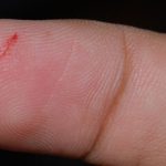 Báo động căn bệnh gây tử vong từ 1 vết xước nhỏ