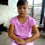 Vết bầm trên da