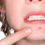 Vì sao vi khuẩn chỉ gây mụn ở một số người?