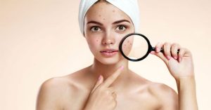 16 vị trí của mụn cảnh báo về sức khỏe