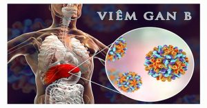 Bệnh viêm gan siêu vi B là gì?