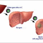 Bệnh viêm gan C: Nguyên nhân, triệu chứng và cách điều trị