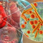 Viêm phổi do Mycoplasma: Nguyên nhân,triệu chứng và cách điều trị