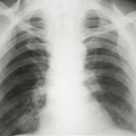Phát hiện thêm về virus EMC mới gây viêm phổi