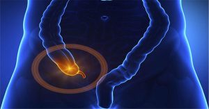 Tắc ruột non: Nguyên nhân, triệu chứng và cách điều trị