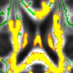 Mỡ bụng cảnh báo bệnh Alzheimer?