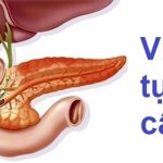 Viêm tuỵ cấp: Triệu chứng, phương pháp điều trị và cách phòng tránh
