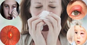 Tại sao viêm mũi xoang lại có thể gây mù mắt?